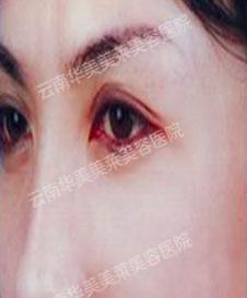 注射除皱